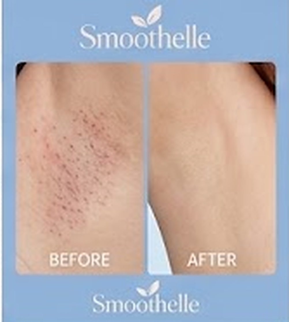Ingrown Hair Smoothing Roller